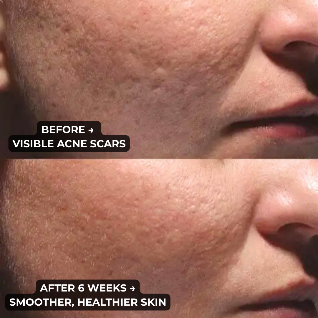 OVELLE Silicone Scar Stick