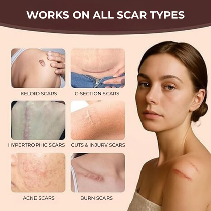 OVELLE Silicone Scar Stick